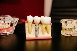model of dental implant on table