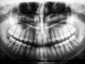 x-ray of human teeth